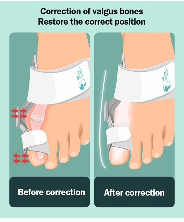 Toe Straightener Corrector - Image 7